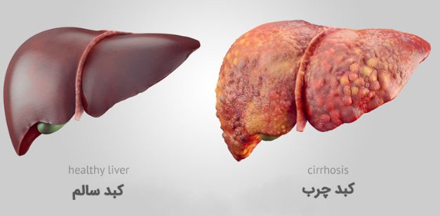 کبد چرب را جدی بگیرید!