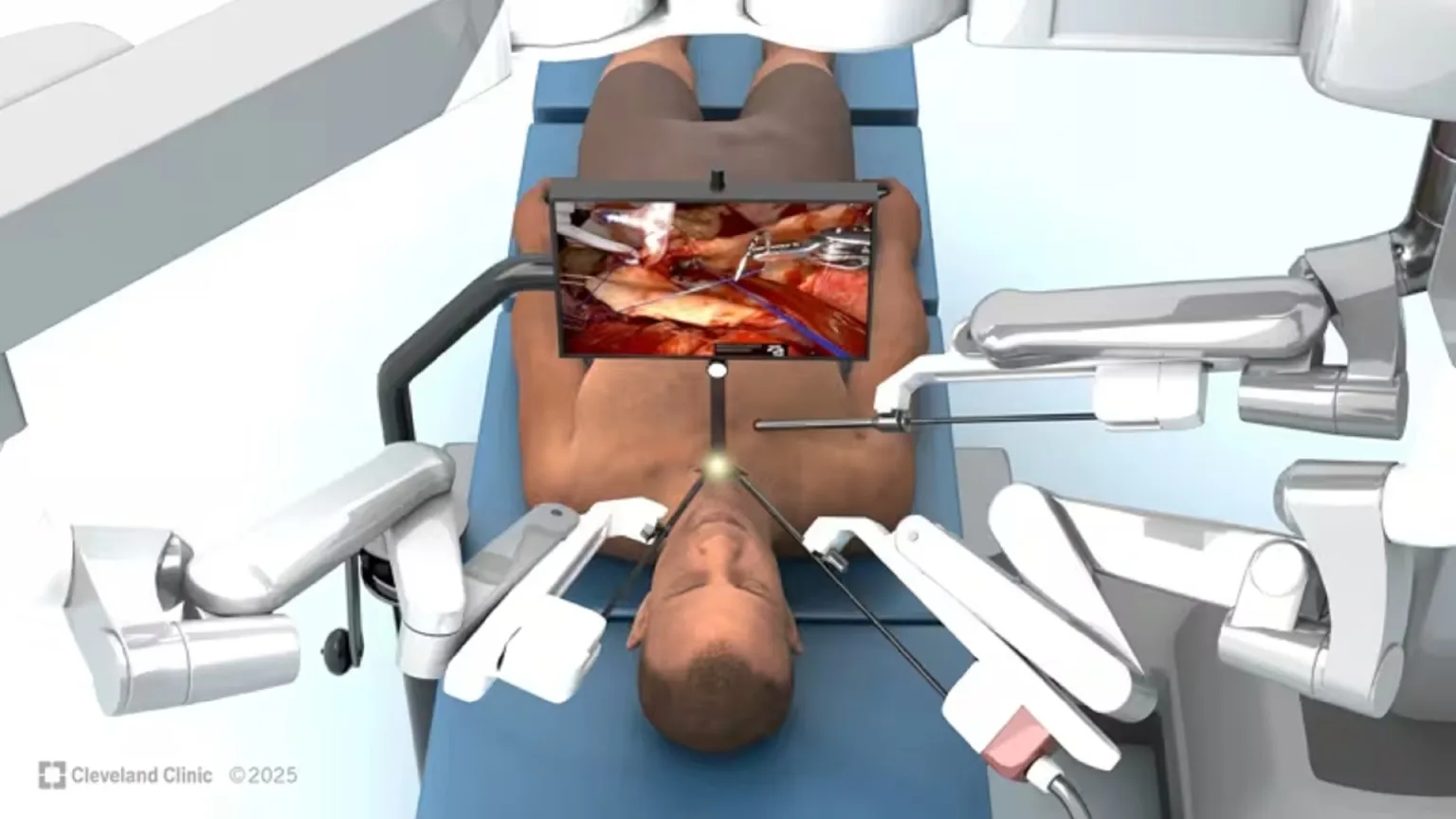 تعویض دریچه قلب بدون باز کردن قفسه سینه در جهان